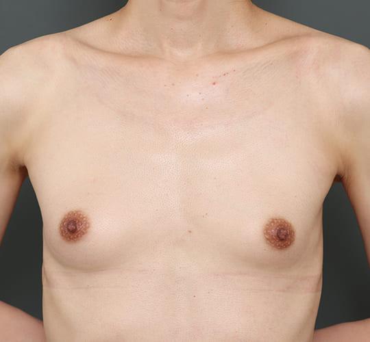 40代男性のMTF豊胸(トランスジェンダー豊胸) Before 症例写真