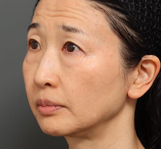 60代女性のVラインサクションリフト After 症例写真