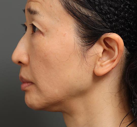 60代女性の顔の脂肪吸引 After 症例写真