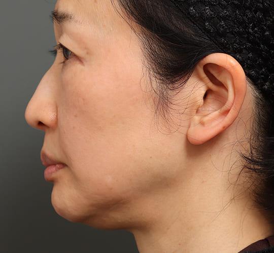 60代女性の顔の脂肪吸引 Before 症例写真