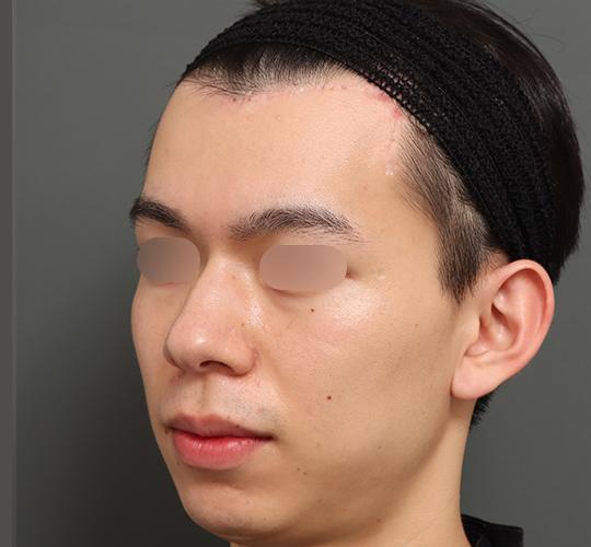 20代男性の額縮小 After 症例写真