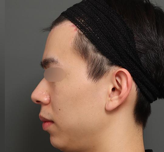 20代男性の額縮小 After 症例写真