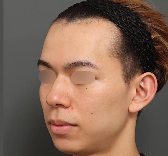 20代男性の額縮小 Before 症例写真