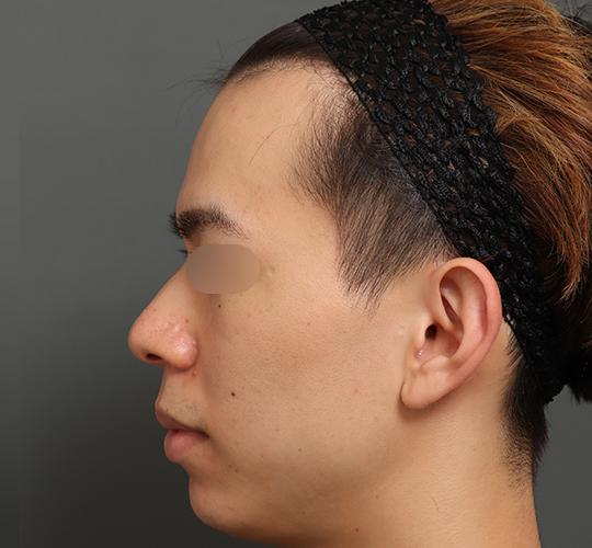 20代男性の額縮小 Before 症例写真