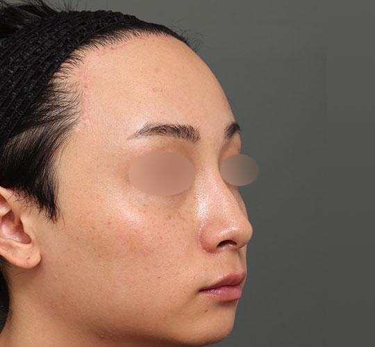 20代男性の額縮小 After 症例写真