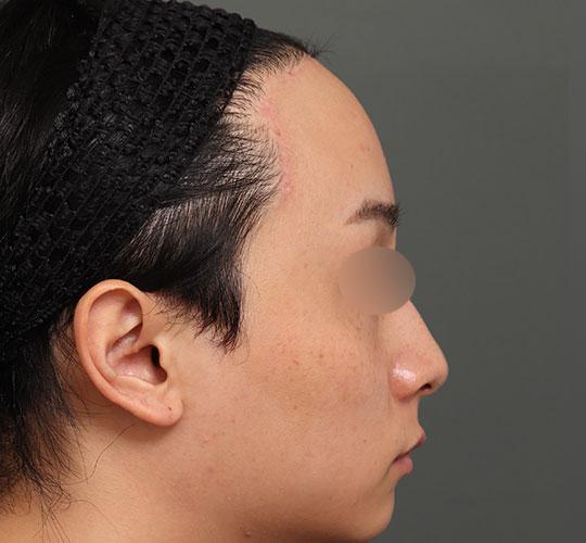 20代男性の額縮小 After 症例写真