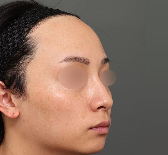 20代男性の額縮小 Before 症例写真