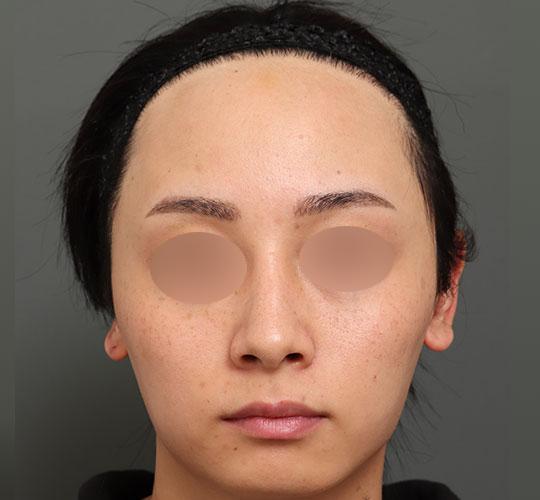 20代男性の額縮小 Before 症例写真