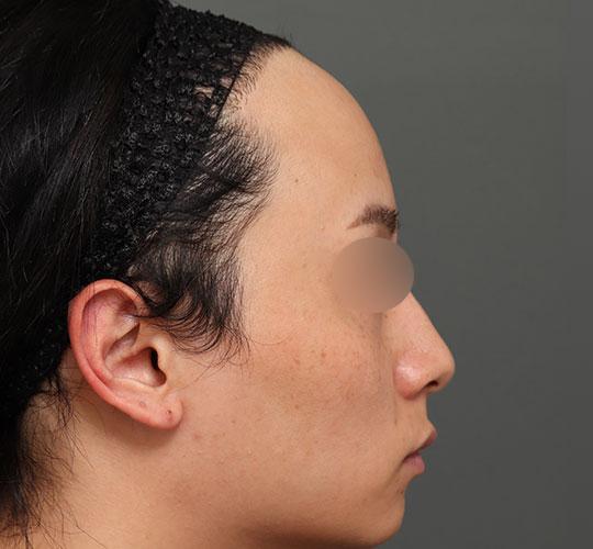 20代男性の額縮小 Before 症例写真