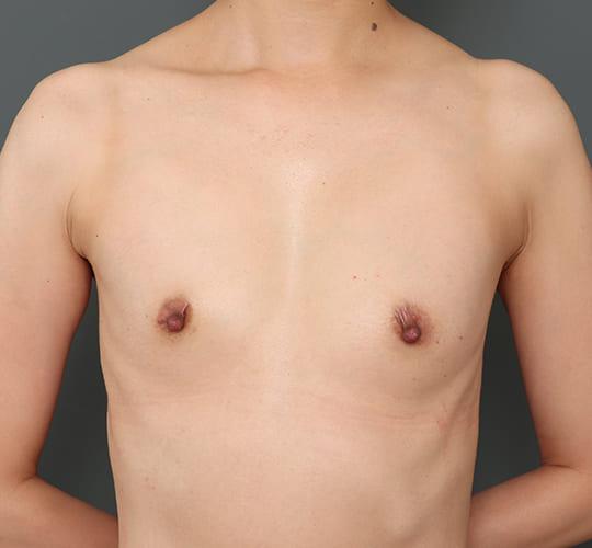 40代女性の豊胸バッグナトレル Before 症例写真