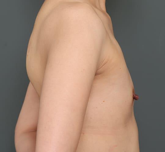 40代女性の豊胸バッグナトレル Before 症例写真