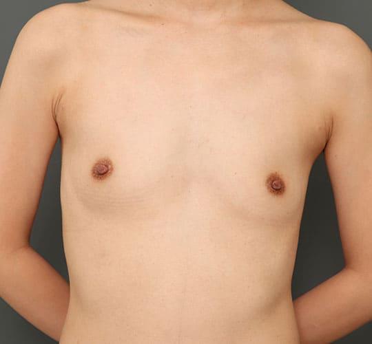 20代女性の豊胸バッグナトレル Before 症例写真