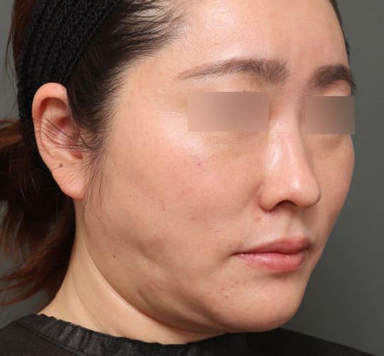 40代女性の顔の脂肪吸引  After 症例写真