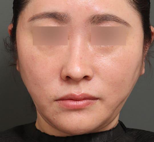 40代女性の顔の脂肪吸引  After 症例写真