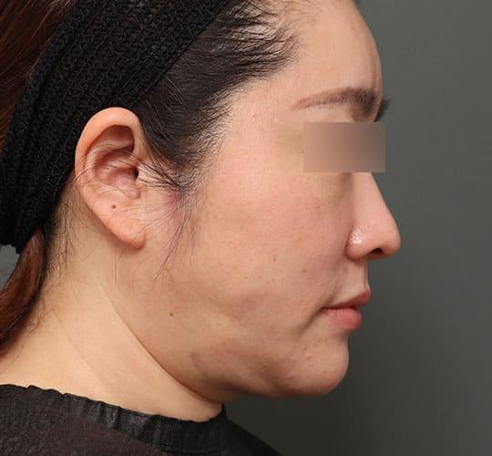 40代女性の顔の脂肪吸引 After 症例写真