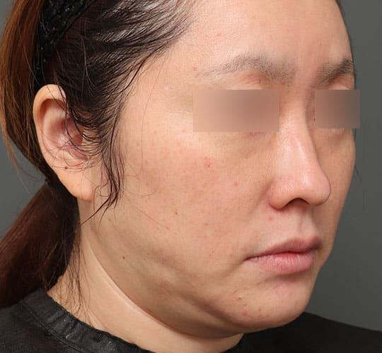40代女性の顔の脂肪吸引  Before 症例写真