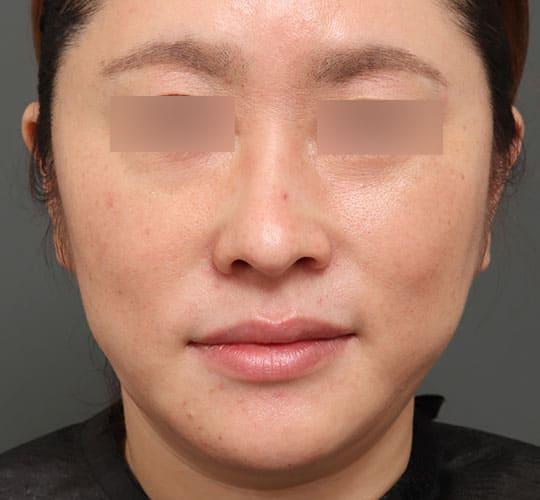 40代女性の顔の脂肪吸引  Before 症例写真