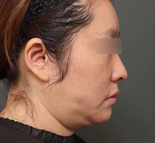 40代女性の顔の脂肪吸引 Before 症例写真