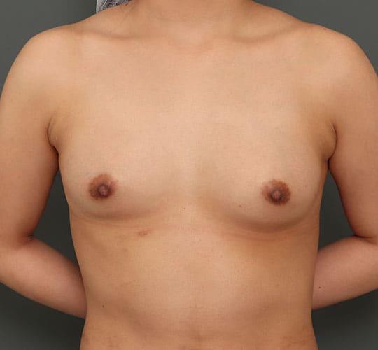 20代女性の豊胸バッグMotiva(モティバ) エルゴノミックス Before 症例写真