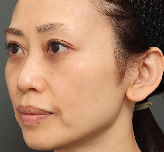 50代女性の3Dリポアイリフト  After 症例写真