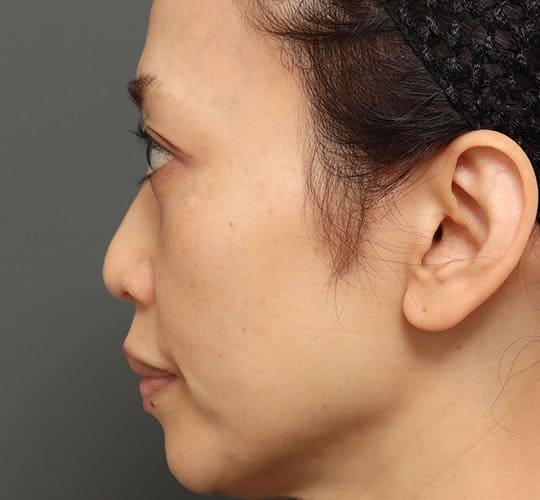 50代女性の3Dリポアイリフト  After 症例写真