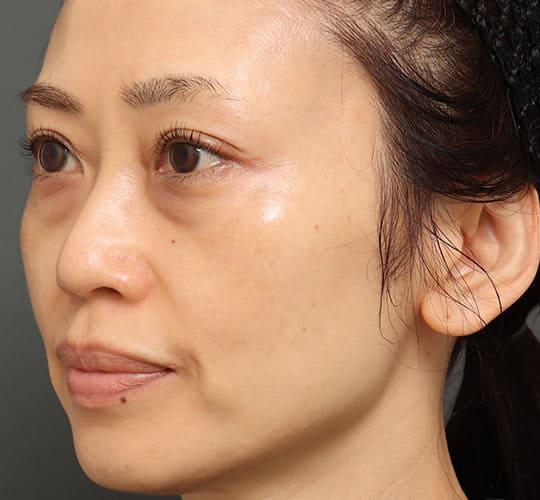 50代女性の3Dリポアイリフト  Before 症例写真