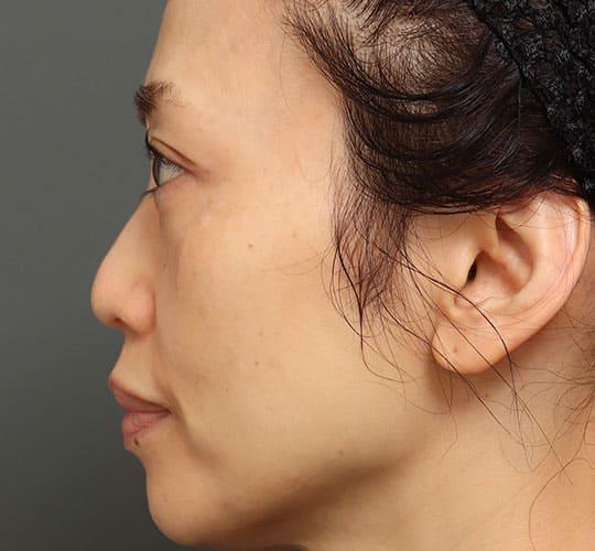 50代女性の3Dリポアイリフト  Before 症例写真