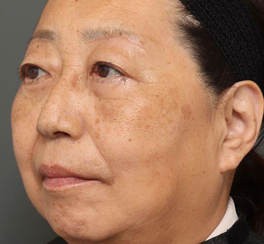 50代女性のハムラ法(目の下のたるみ取り) After 症例写真