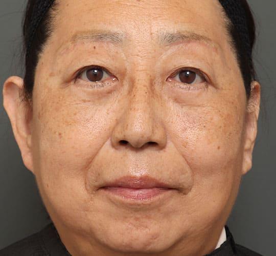 50代女性のハムラ法(目の下のたるみ取り) After 症例写真