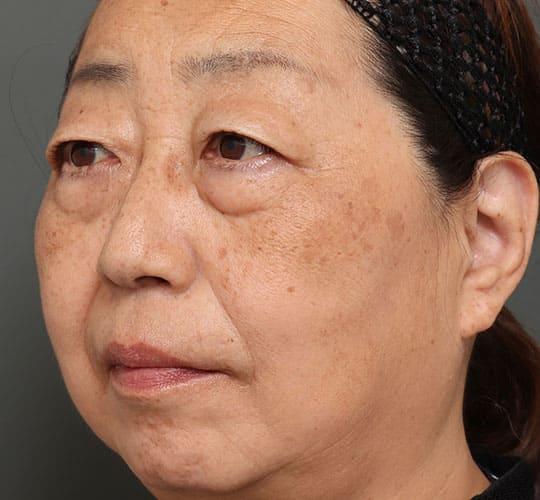 50代女性のハムラ法(目の下のたるみ取り) Before 症例写真