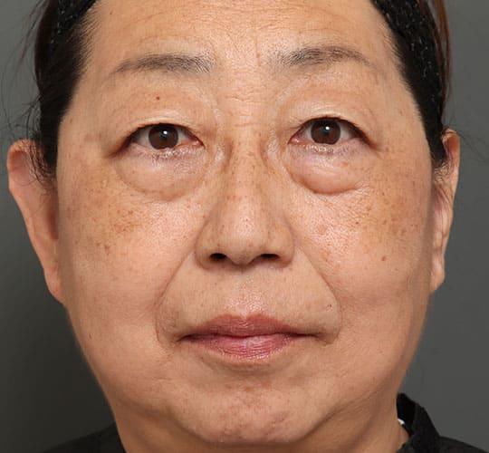 50代女性のハムラ法(目の下のたるみ取り) Before 症例写真