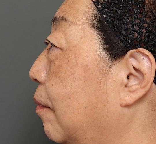 50代女性のハムラ法(目の下のたるみ取り) Before 症例写真