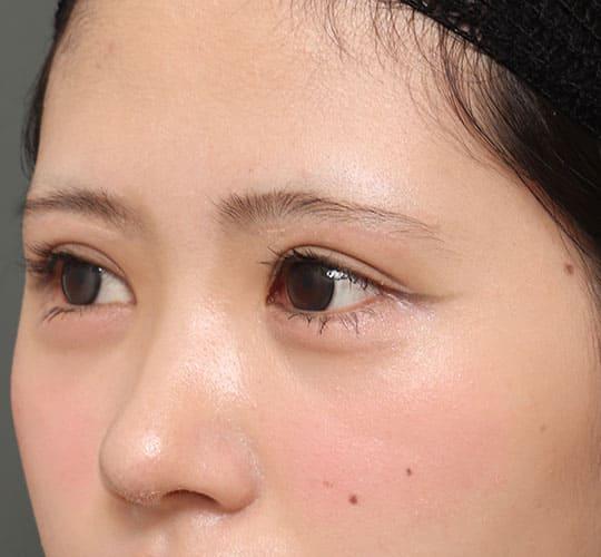 20代女性の眉下切開法 After 症例写真