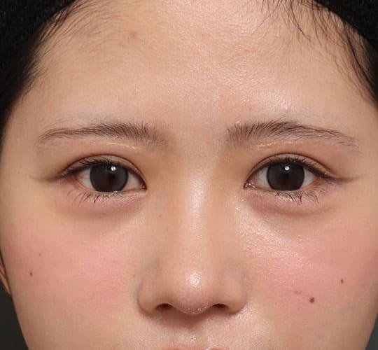 20代女性の眉下切開法 After 症例写真