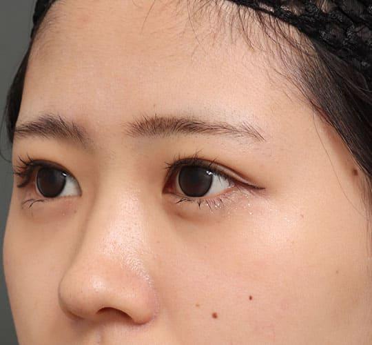 20代女性の眉下切開法 Before 症例写真