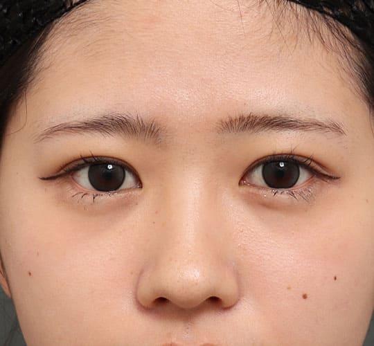 20代女性の眉下切開法 Before 症例写真