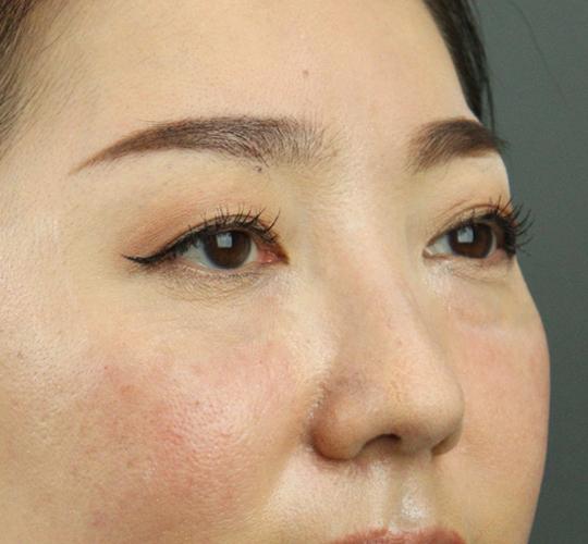 40代女性のヒアルロン酸注射（目の下） After 症例写真