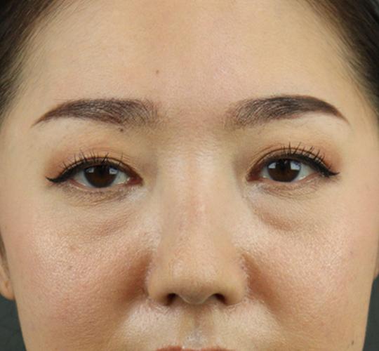 40代女性のヒアルロン酸注射 Before 症例写真