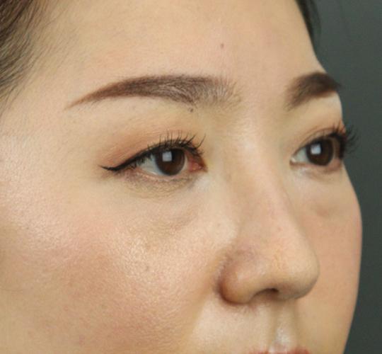 40代女性のヒアルロン酸注射（目の下） Before 症例写真