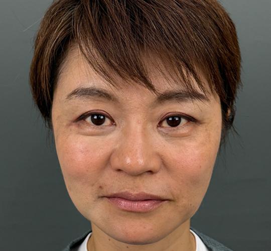 50代女性の輪郭オーダーメイド注入 After 症例写真