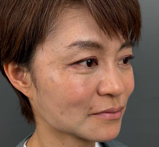 50代女性の輪郭オーダーメイド注入 After 症例写真