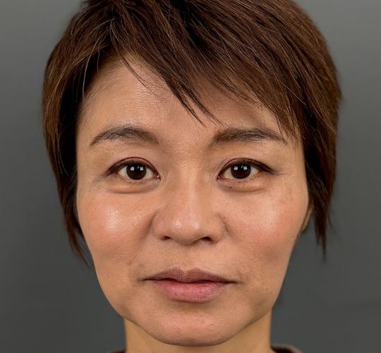 50代女性の輪郭オーダーメイド注入 Before 症例写真