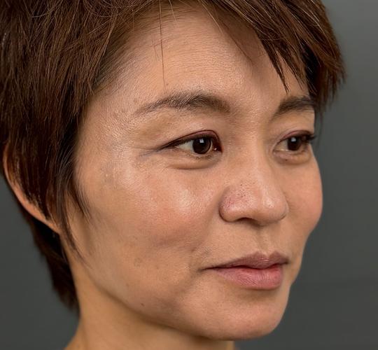 50代女性の輪郭オーダーメイド注入 Before 症例写真