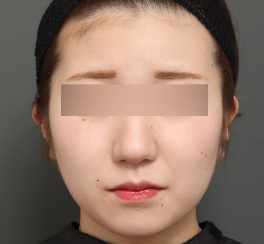 10代女性のバッカルファット除去 After 症例写真