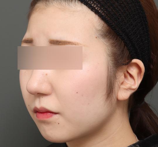 10代女性のバッカルファット除去 After 症例写真