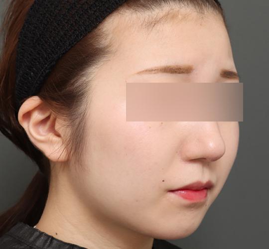 10代女性のバッカルファット除去 After 症例写真