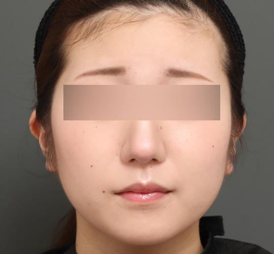 10代女性のバッカルファット除去 Before 症例写真
