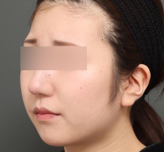 10代女性のバッカルファット除去 Before 症例写真