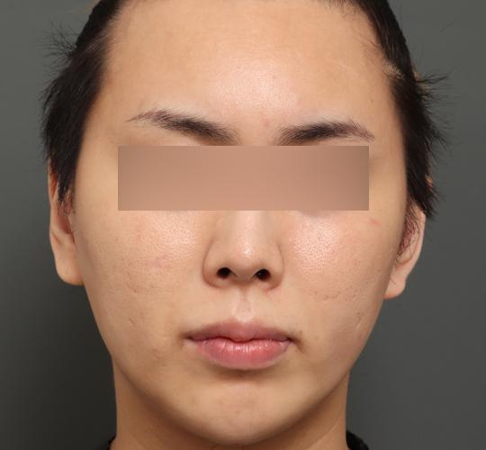 20代男性の顔の脂肪吸引 After 症例写真