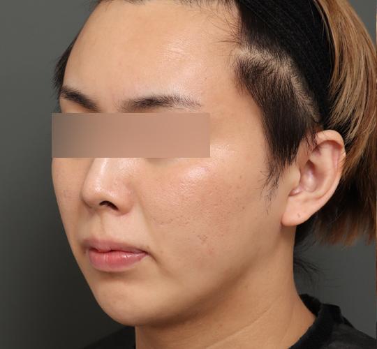20代男性の顔の脂肪吸引  After 症例写真